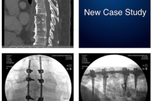 Thoracic Spine Fractures