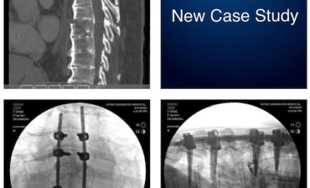 Thoracic Spine Fractures