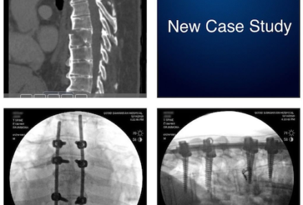 Thoracic Spine Fractures