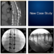 Thoracic Spine Fractures