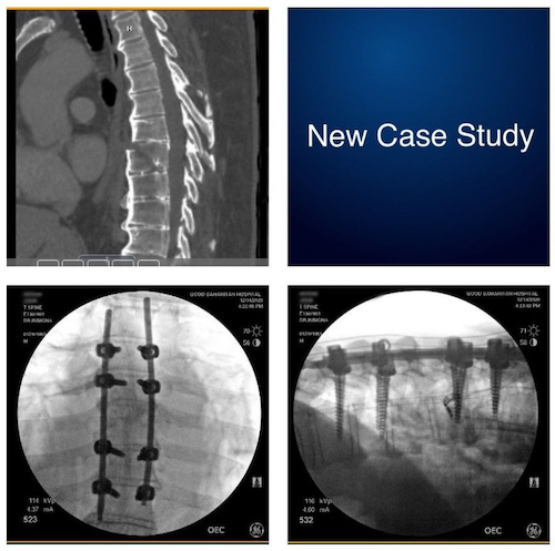 Thoracic Spine Fractures