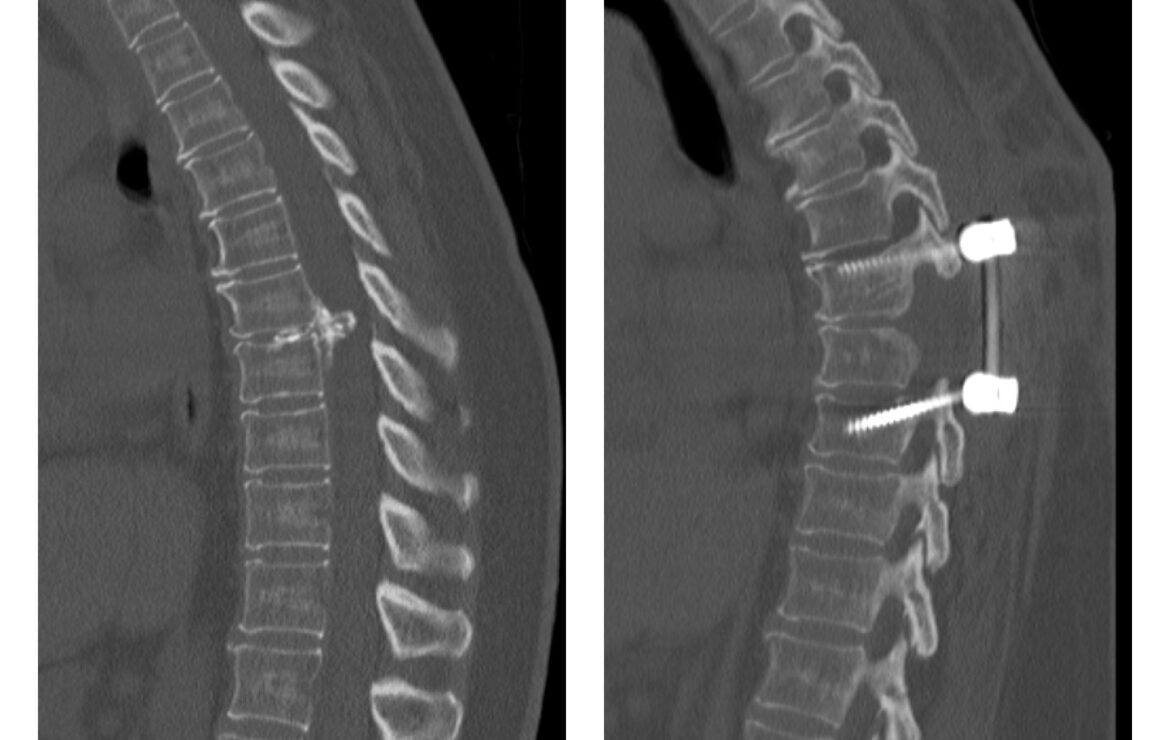 Thoracic Disc Resection and Fusion