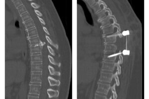 Thoracic Disc Resection and Fusion